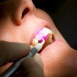 Laser gengive costo