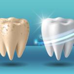 Microfratture smalto denti