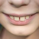 Overjet e overbite