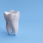 Pezzi di denti che si staccano