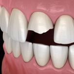 Pezzo di dente staccato