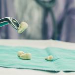 Pinze estrazione denti