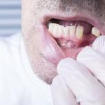 Quanto costa aggiustare un dente rotto