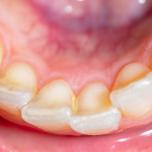 Quanto dura un colletto dentale