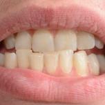 Raddrizzare un solo dente