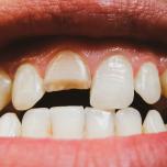 Ricostruzione dente spezzato