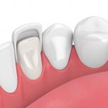 Ricostruzione estetica denti