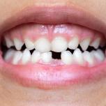 Ritardo crescita dente definitivo