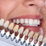 Scala colori denti