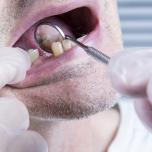 Senza denti a 40 anni