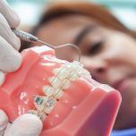 Splintaggio denti inferiori pulizia 