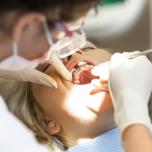 Trapianto denti