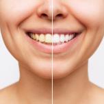 Vitamina D denti gialli