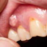 Zitromax per ascesso dentale