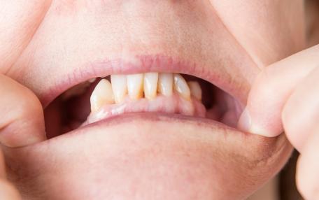 Buco dopo estrazione dente