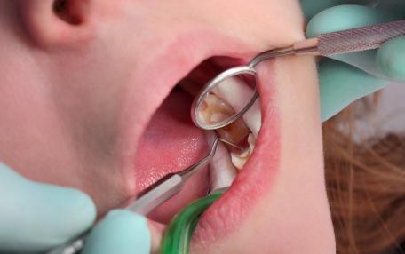 Come chiudere un buco nel dente