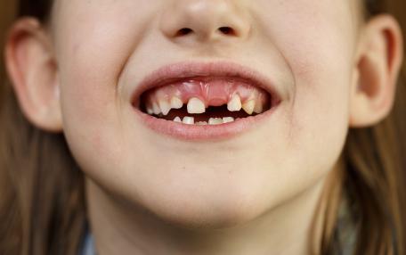 Come far cadere un dente