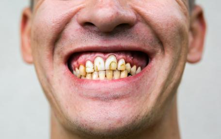 Dente cariato rotto