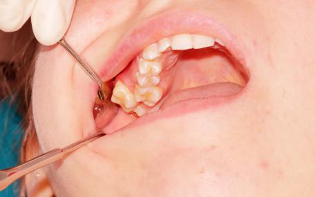 Dente cresciuto sulla gengiva