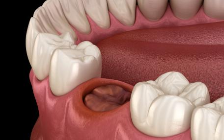 Dente estratto