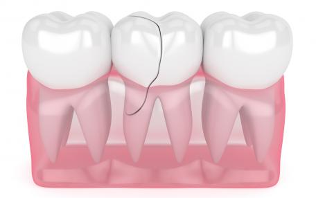 Dente rotto alla radice