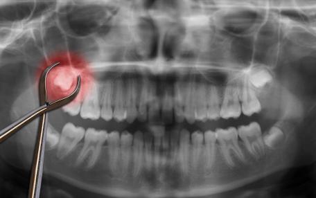 Estrazione dente el giudizio 400 euro