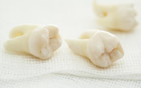Estrazione dente del giudizio quanto dura