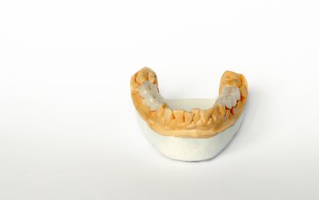 Ricostruzione dentale composito quanto dura