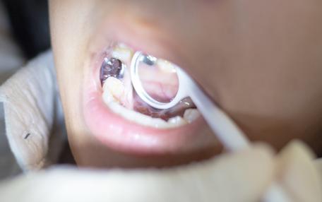 Rimozione amalgama dentale effetti collaterali