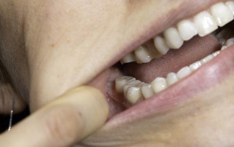 Sintomi dente del giudizio
