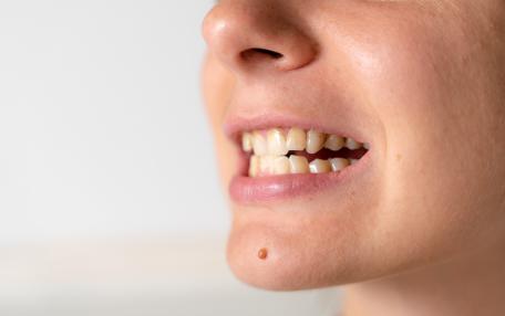 Vitamina D denti gialli