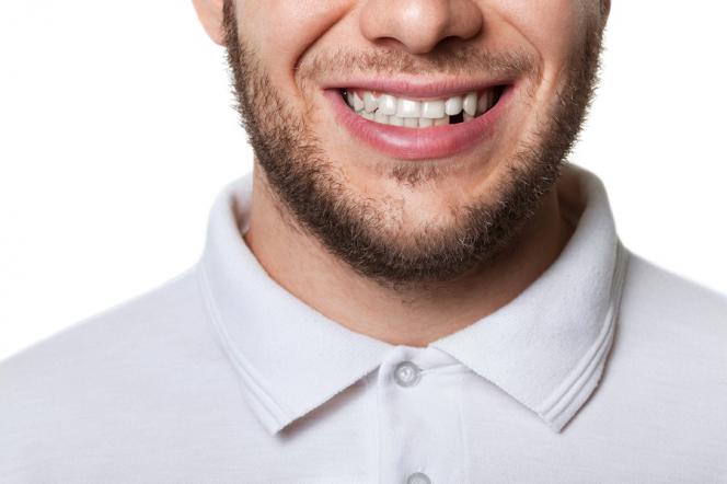 Come nascondere un dente mancante Come nascondere un dente mancante