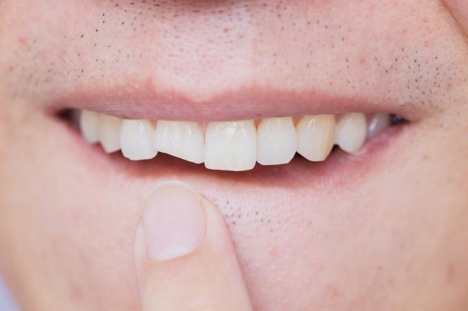 Come nascondere un dente rotto Come nascondere un dente rotto
