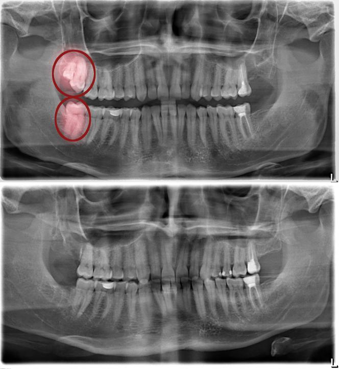Cosa fare dopo estrazione dente del giudizio Cosa fare dopo estrazione dente del giudizio