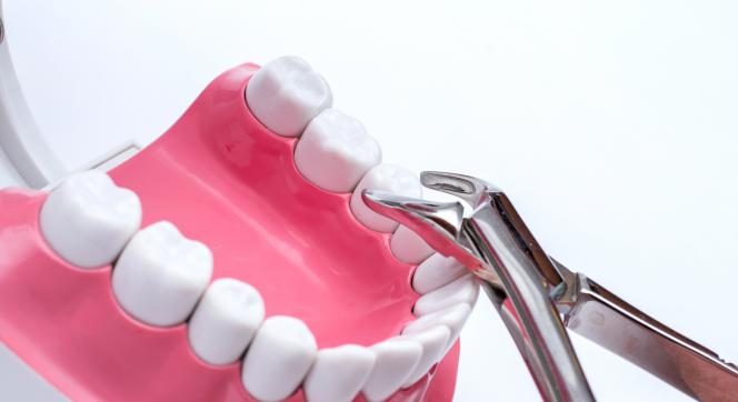 Cosa fare dopo estrazione dente Cosa fare dopo estrazione dente