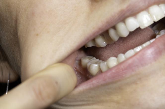 Dente del giudizio incluso Dente del giudizio incluso