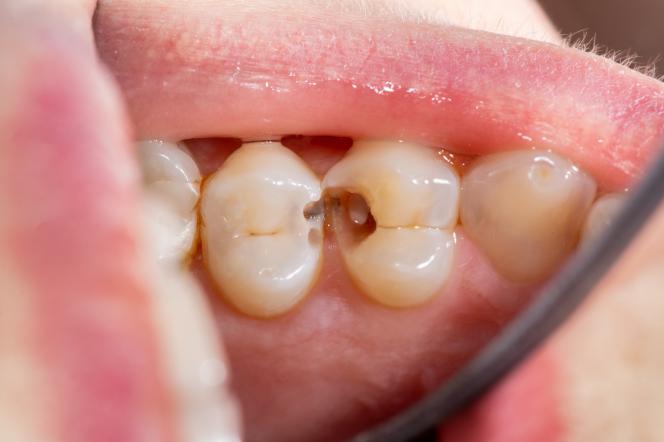 Dente marcio sintomi Dente marcio sintomi