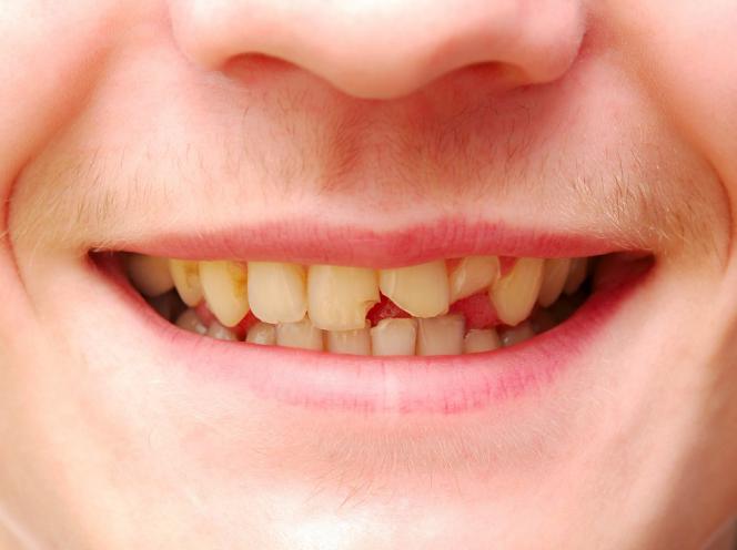 Dente rotto Dente rotto