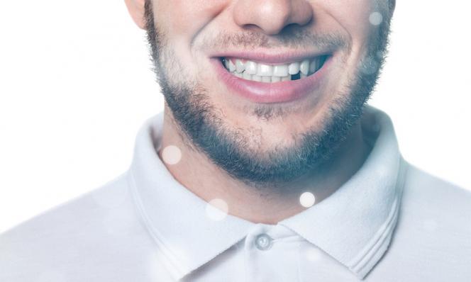 Dente scheggiato Dente scheggiato