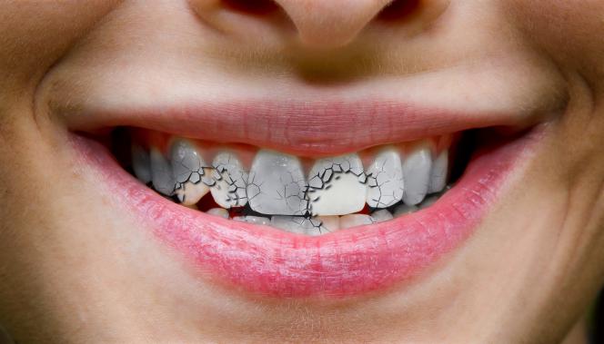Denti fragili Denti fragili