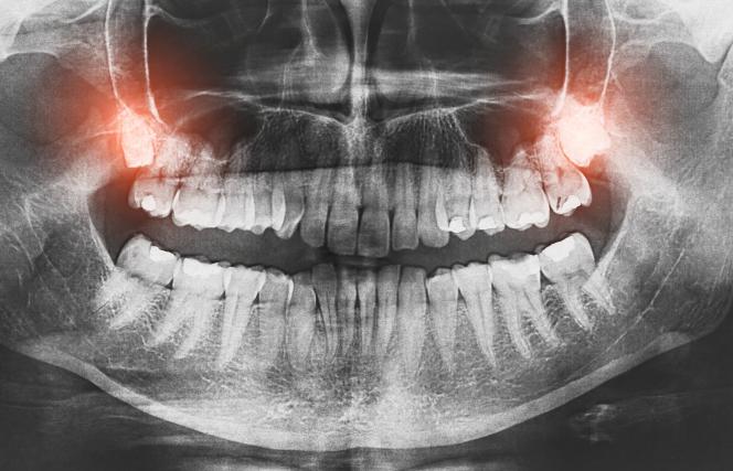 Quanto Costa Estrazione Dente Del Giudizio