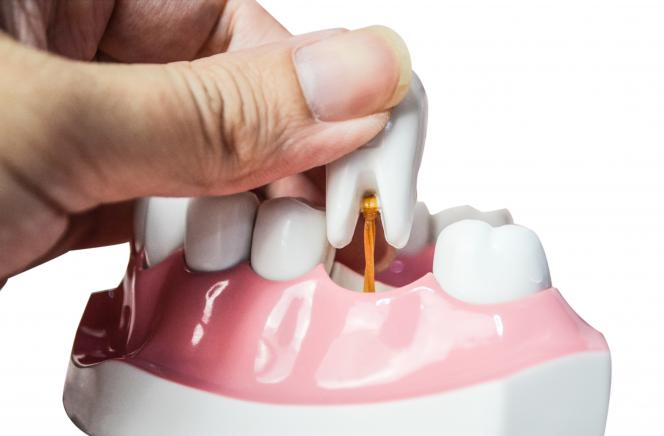 Estrazione dente radice rotta Estrazione dente radice rotta