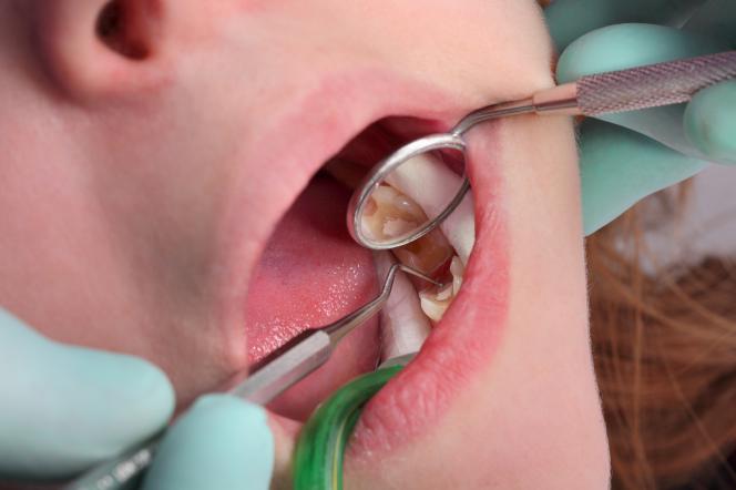 Foro cieco denti Foro cieco denti