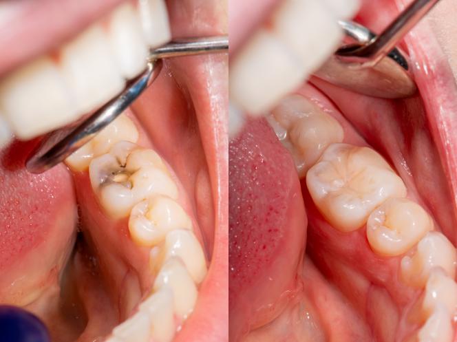Precontatto dentale Precontatto dentale