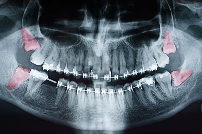 Quante radici ha il dente del giudizio Quante radici ha il dente del giudizio