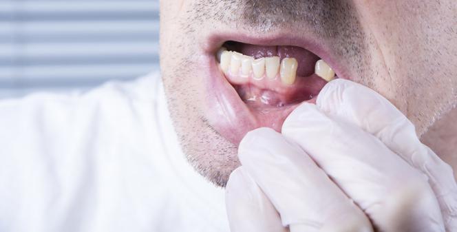 Quanto costa aggiustare un dente rotto Quanto costa aggiustare un dente rotto