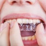 Digrignare i denti di notte rimedi