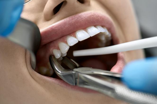 Alveolite dentale Alveolite dentale