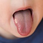 Afte bambini rimedi