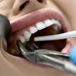 Alveolite dentale